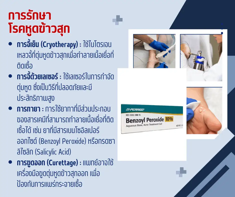 การรักษาโรคหูดข้าวสุกpng
