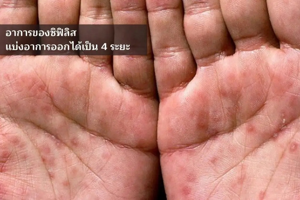 อาการของซิฟิลิส