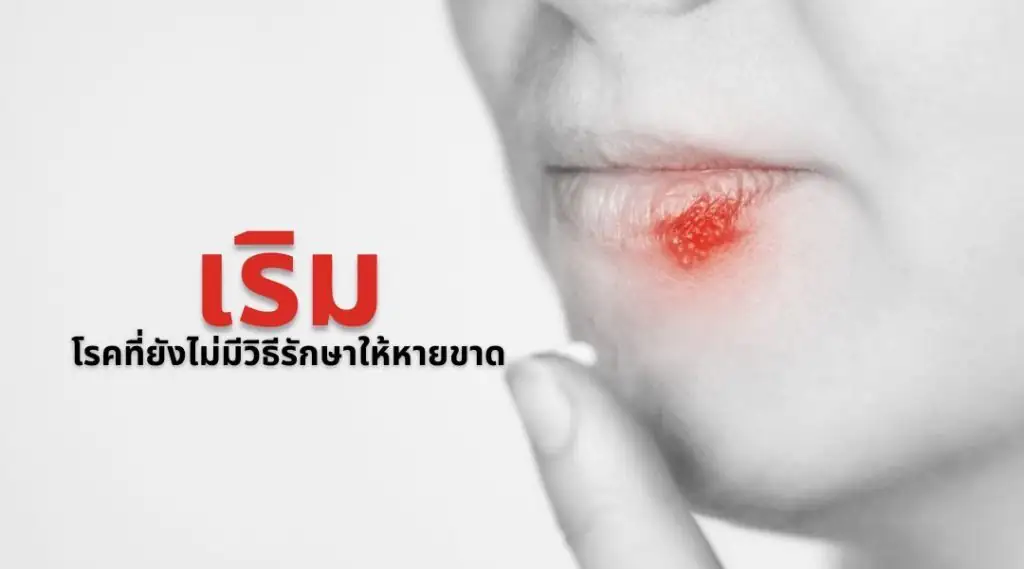 เริม โรคที่ยังไม่มีวิธีรักษาให้หายขาด