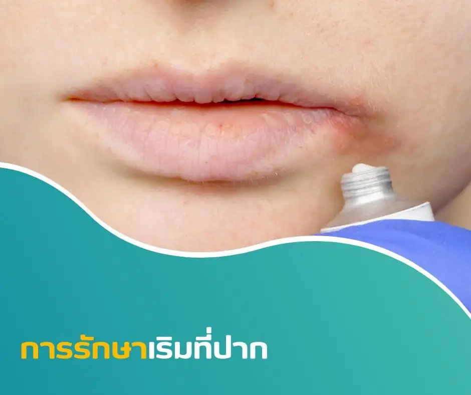 การรักษาเริมที่ปาก