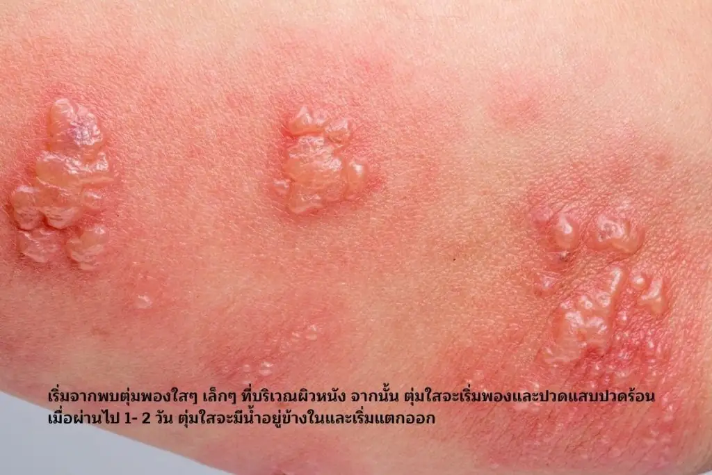 ตุ่มพองใสๆ