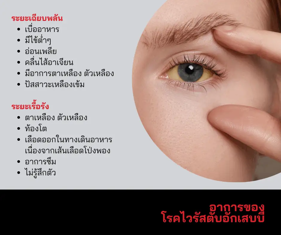 อาการของโรคไวรัสตับอักเสบบี