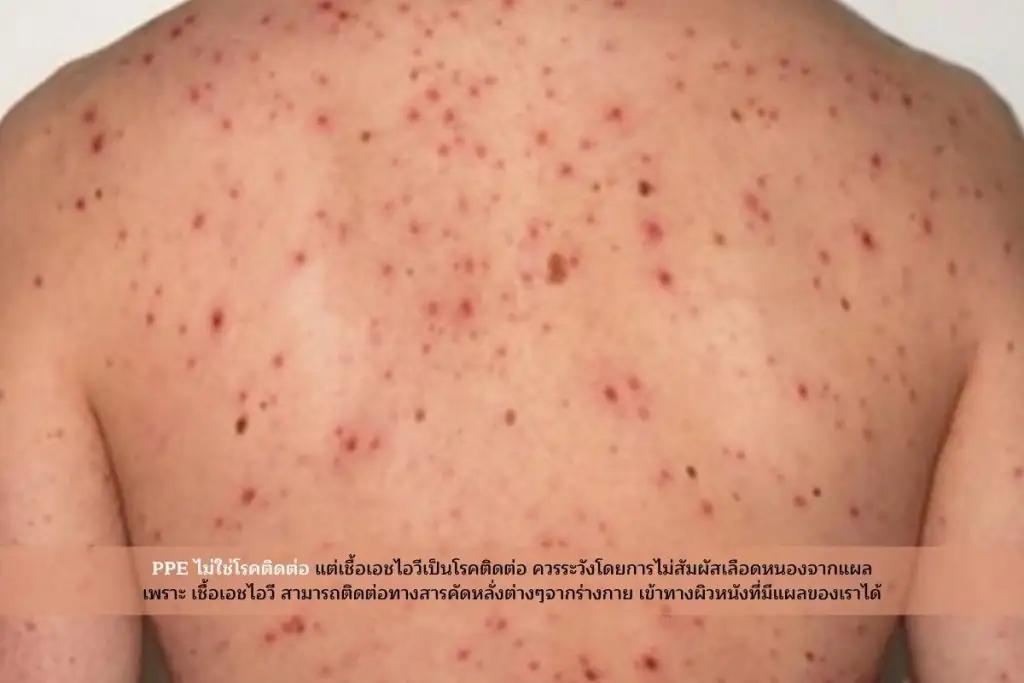 ตุ่มPPEไม่ใช่โรคติดต่อ