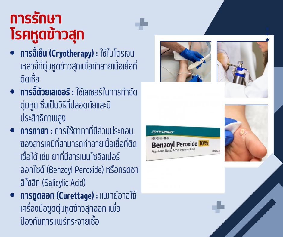 การรักษาโรคหูดข้าวสุกpng