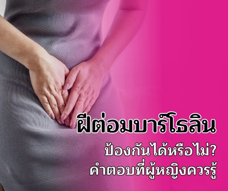 ฝีต่อมบาร์โธลิน ป้องกันได้หรือไม่? คำตอบที่ผู้หญิงควรรู้
