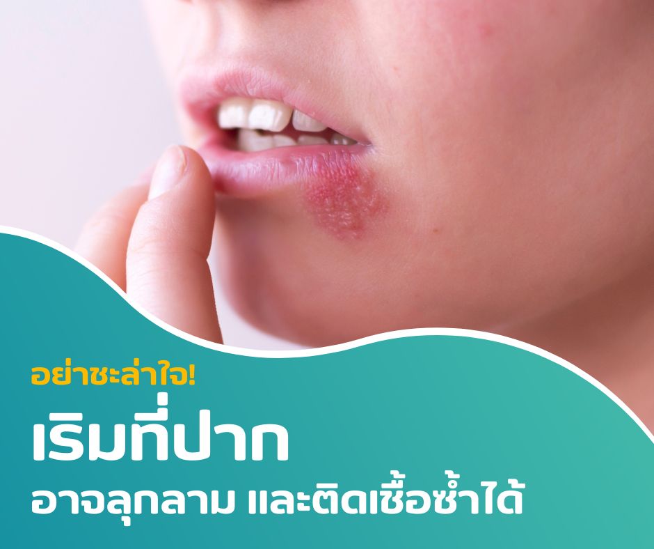 อย่าชะล่าใจ! เริมที่ปากอาจลุกลามและติดเชื้อซ้ำได้