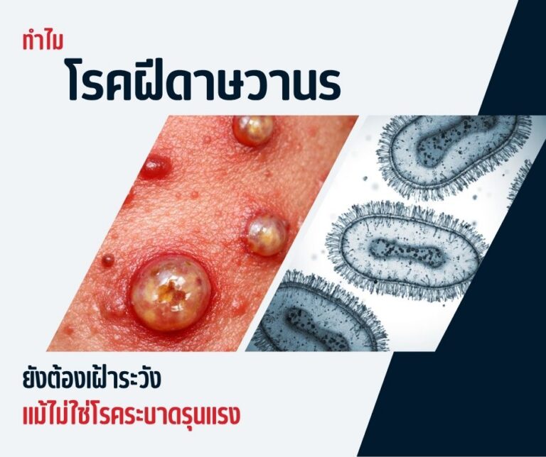 ทำไมโรคฝีดาษวานรยังต้องเฝ้าระวัง แม้ไม่ใช่โรคระบาดรุนแรง